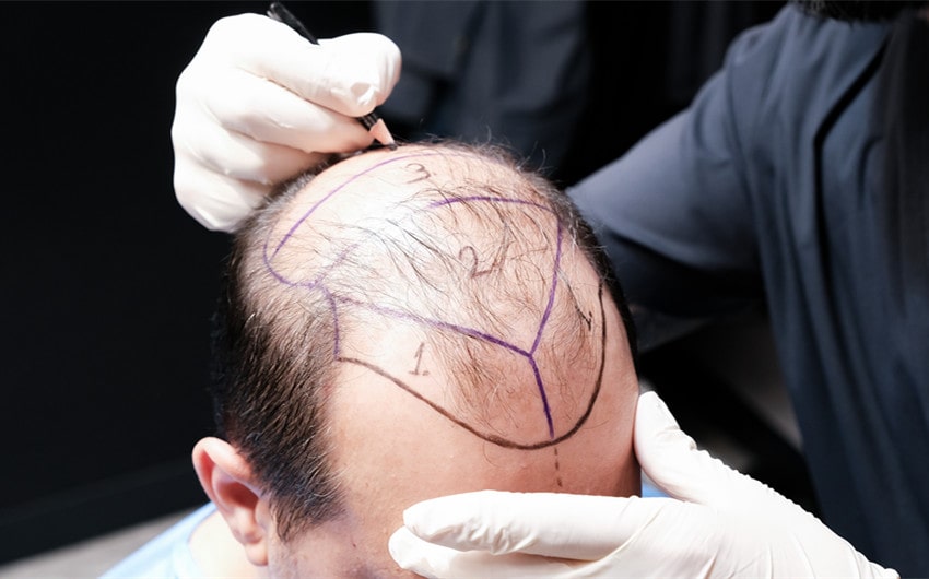How Is a Hair Transplant Procedure Done